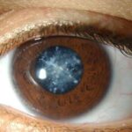 Вторичная катаракта: причины, симптомы и лечение